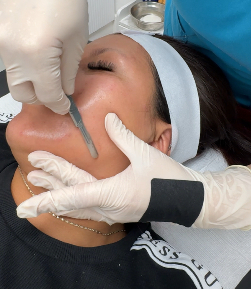 Dermaplaning
