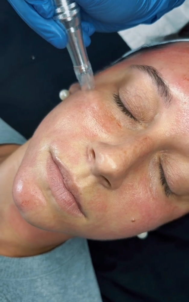 Microneedling