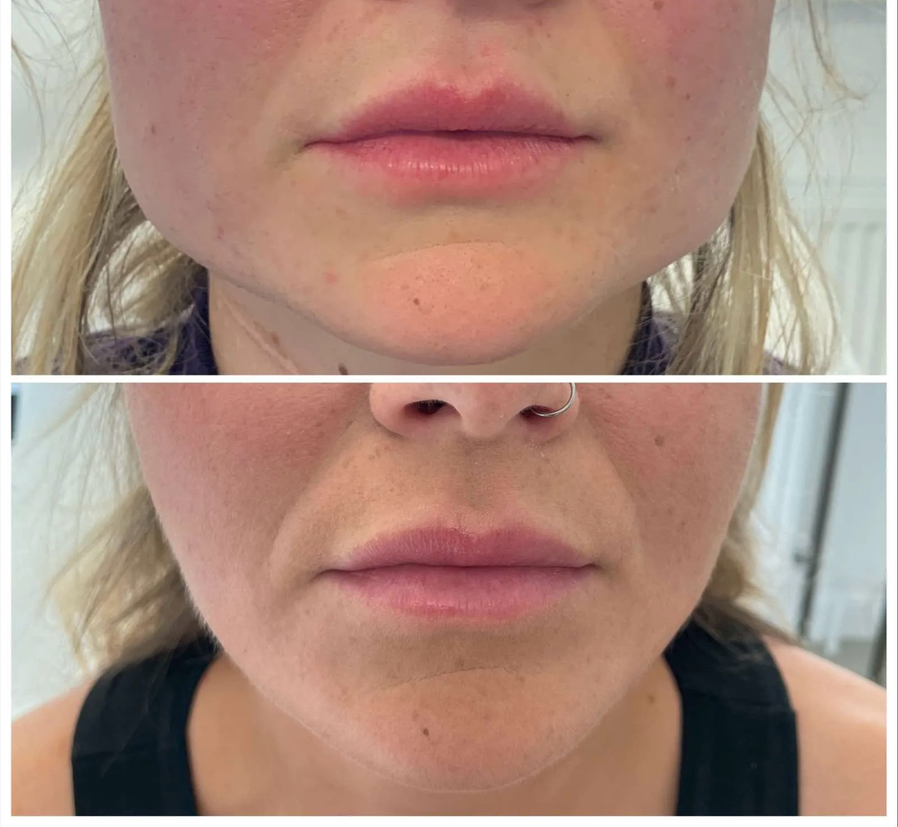 Masseter Botox Treatment •Slim Jaw• at Glam X Sam MedBeauty in Andrews, TX