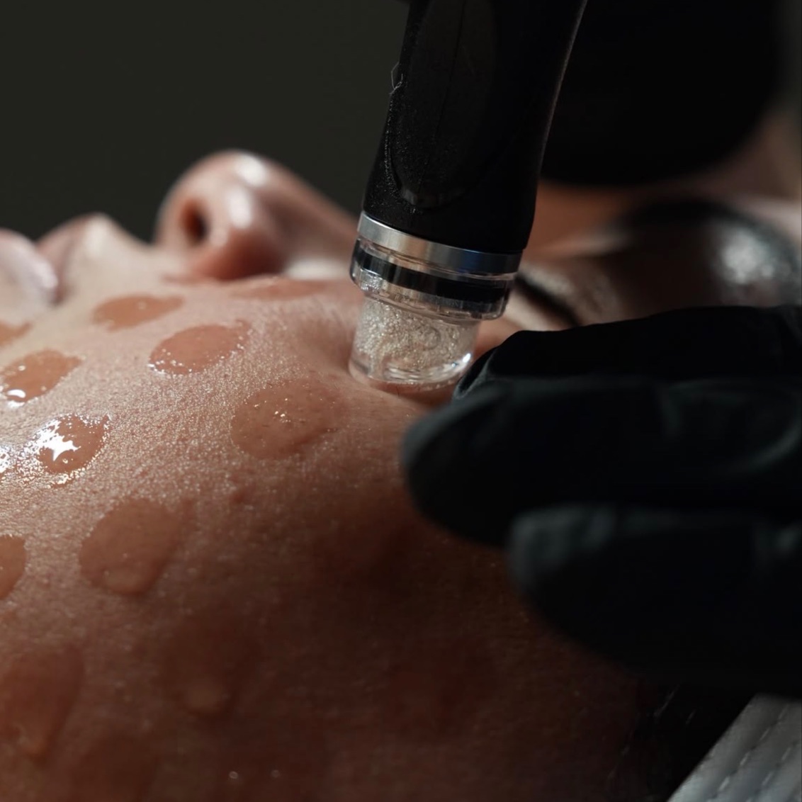 Hydrodermabrasion Facial at Cove Aesthetics in Lexington, VA