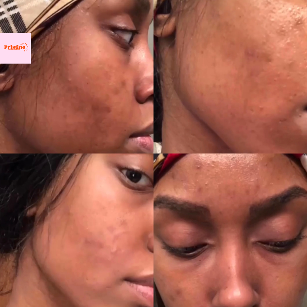 Chemical Peel Facial Add On