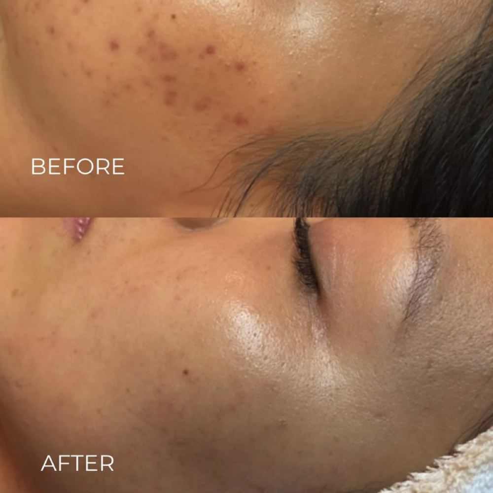 Clarifying Acne Facial at VIVID Skin Studio in Victoria, TX