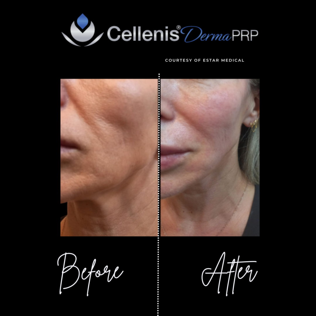 Cellenis Derma PRP