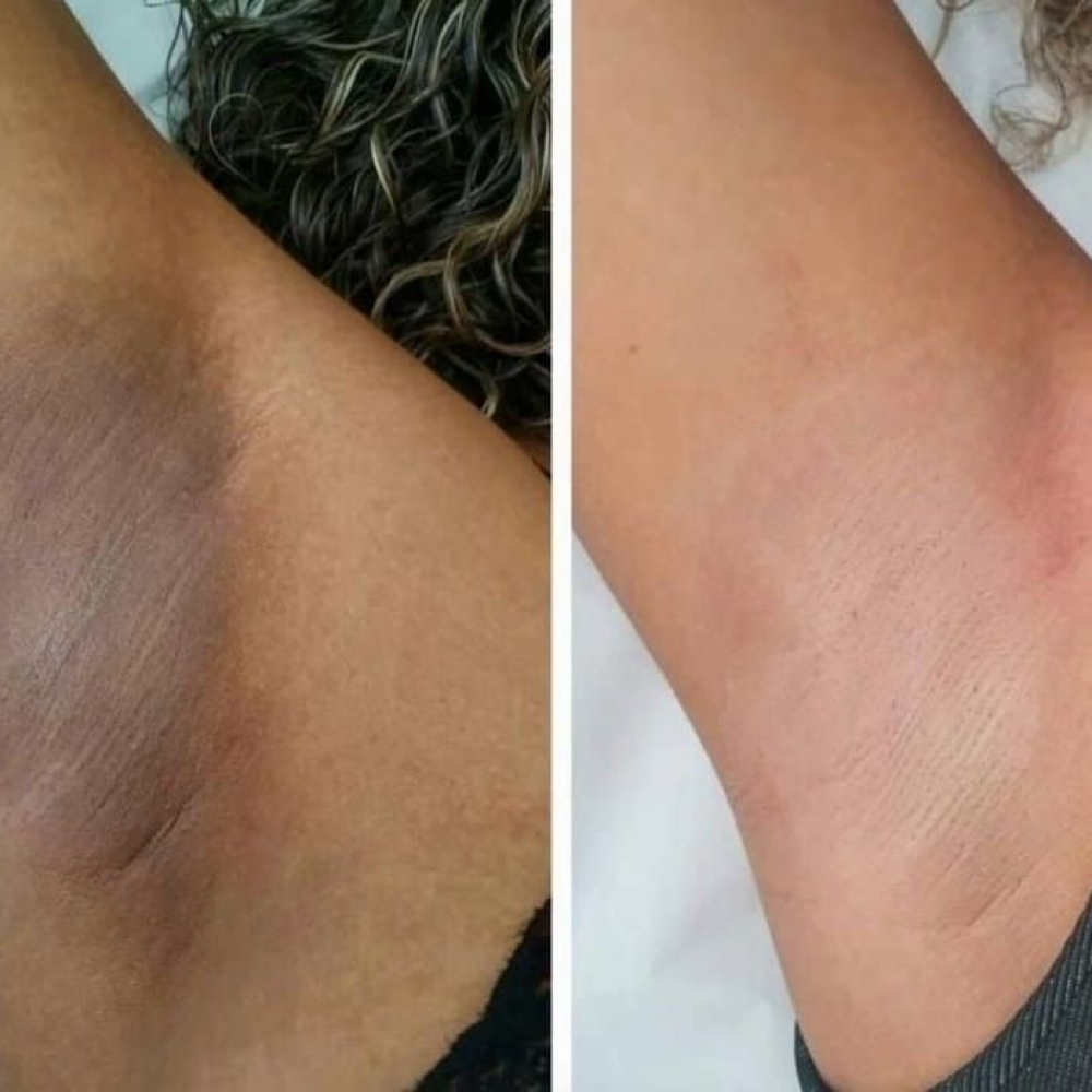 🌸 Underarm Brightening Treatment at Foreign Beauty Aesthetics in Woodbridge, VA