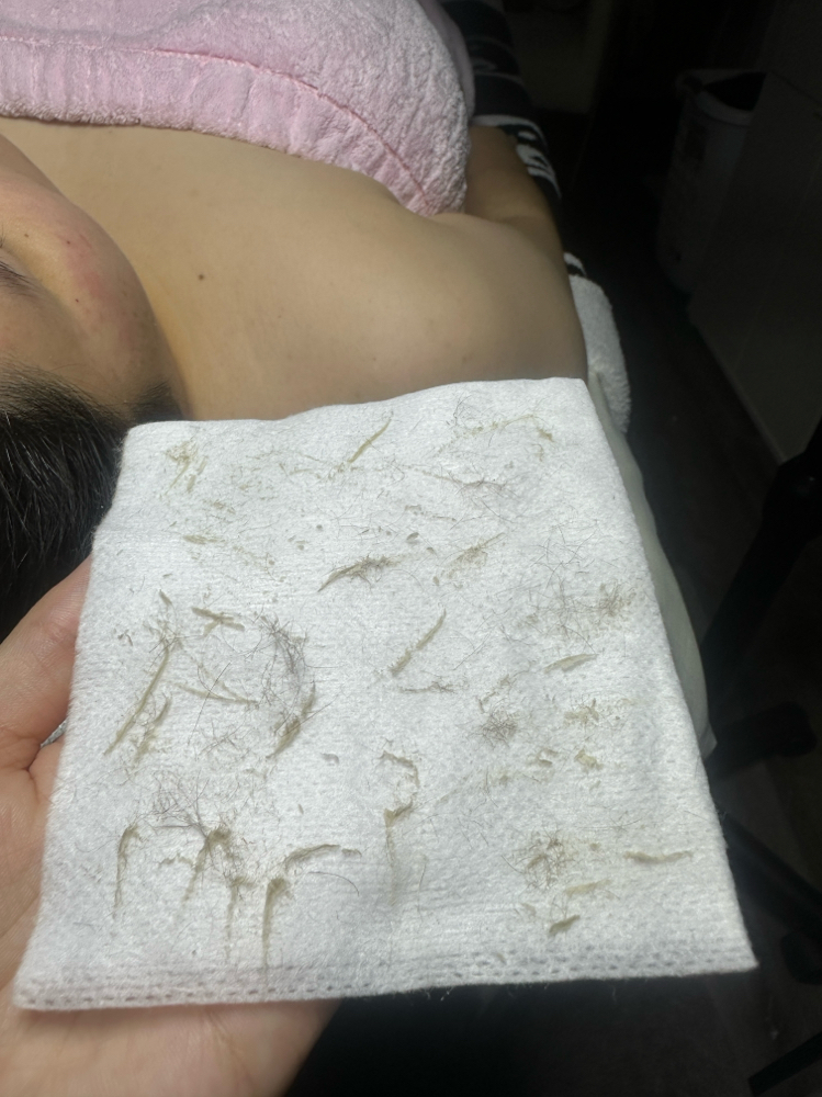 dermaplane facial