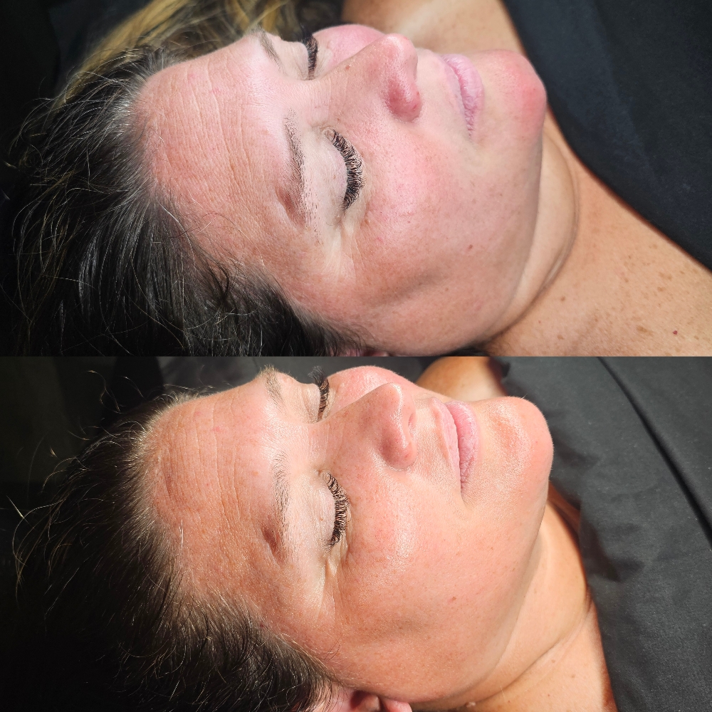 Lymphatic Drainage Facial