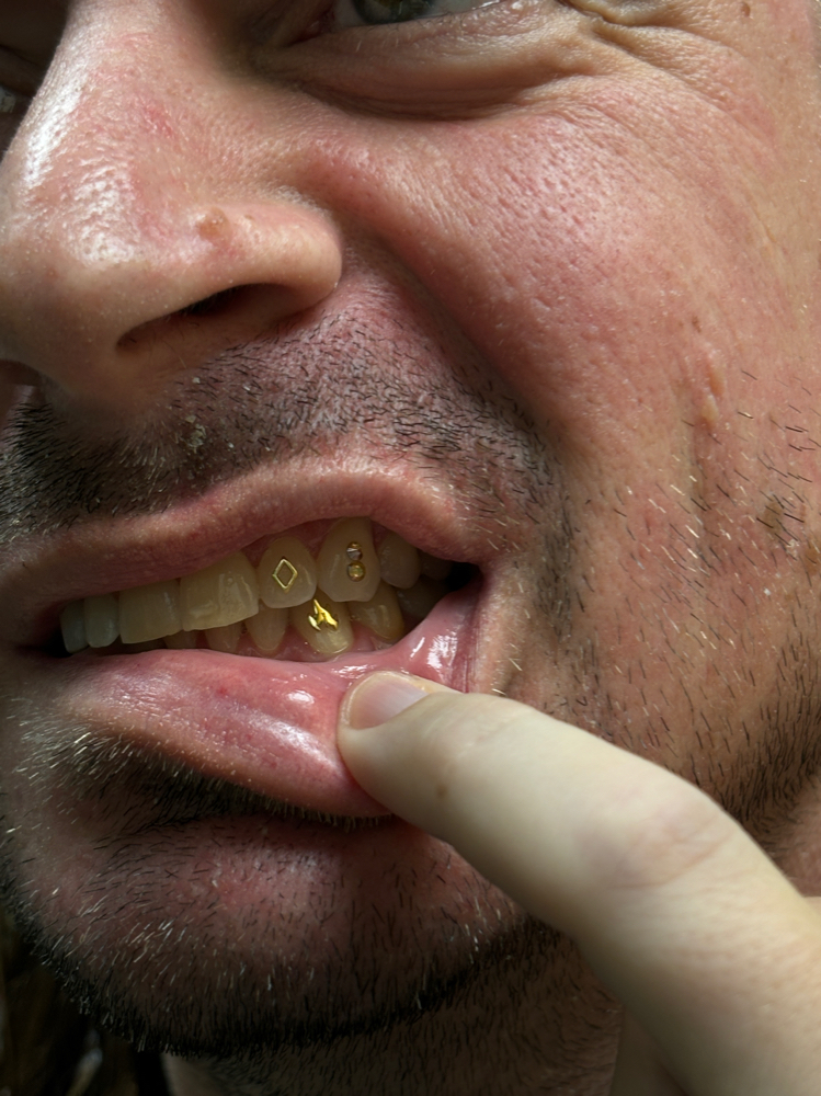 Tooth Gem Service