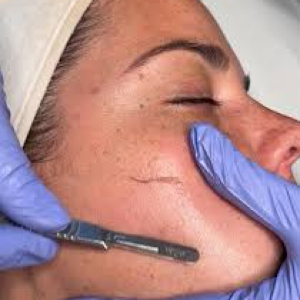 Dermaplane Facial at Luxe Lines and Lips, PLLC in Halls, TN