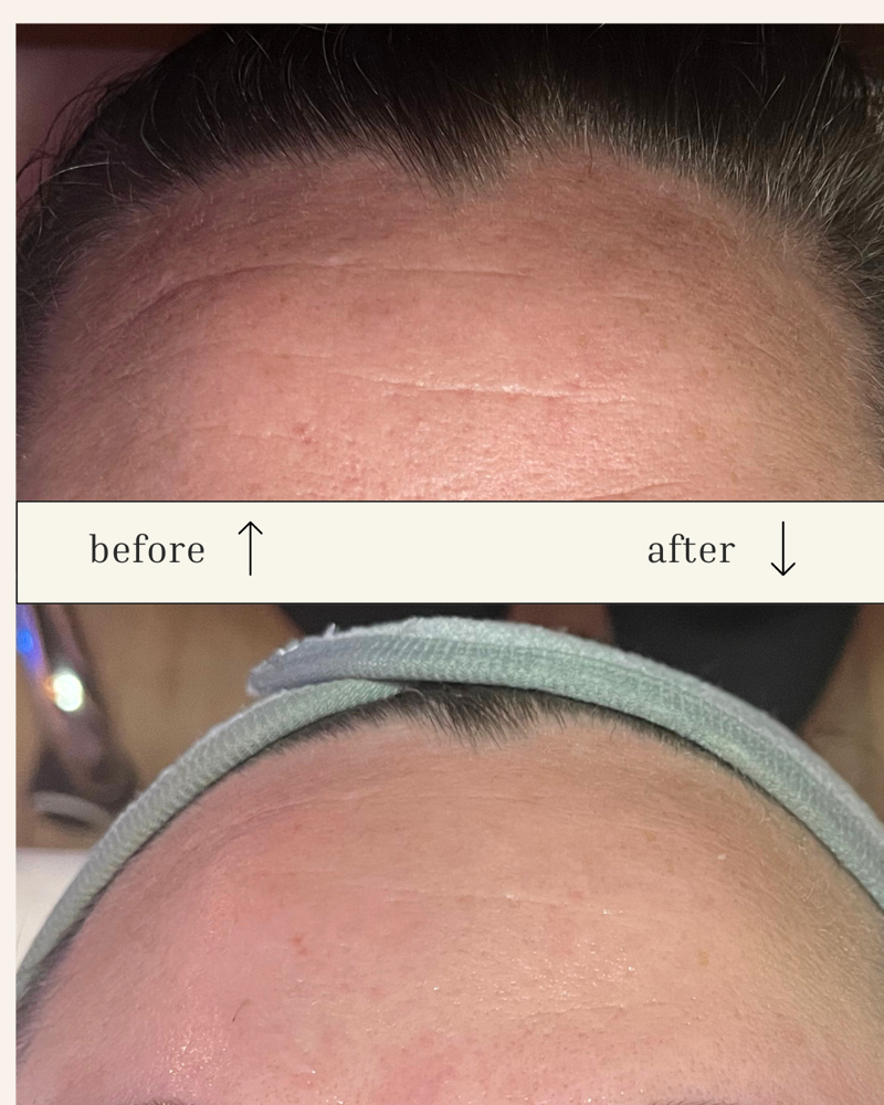 Glow-Tox Facial
