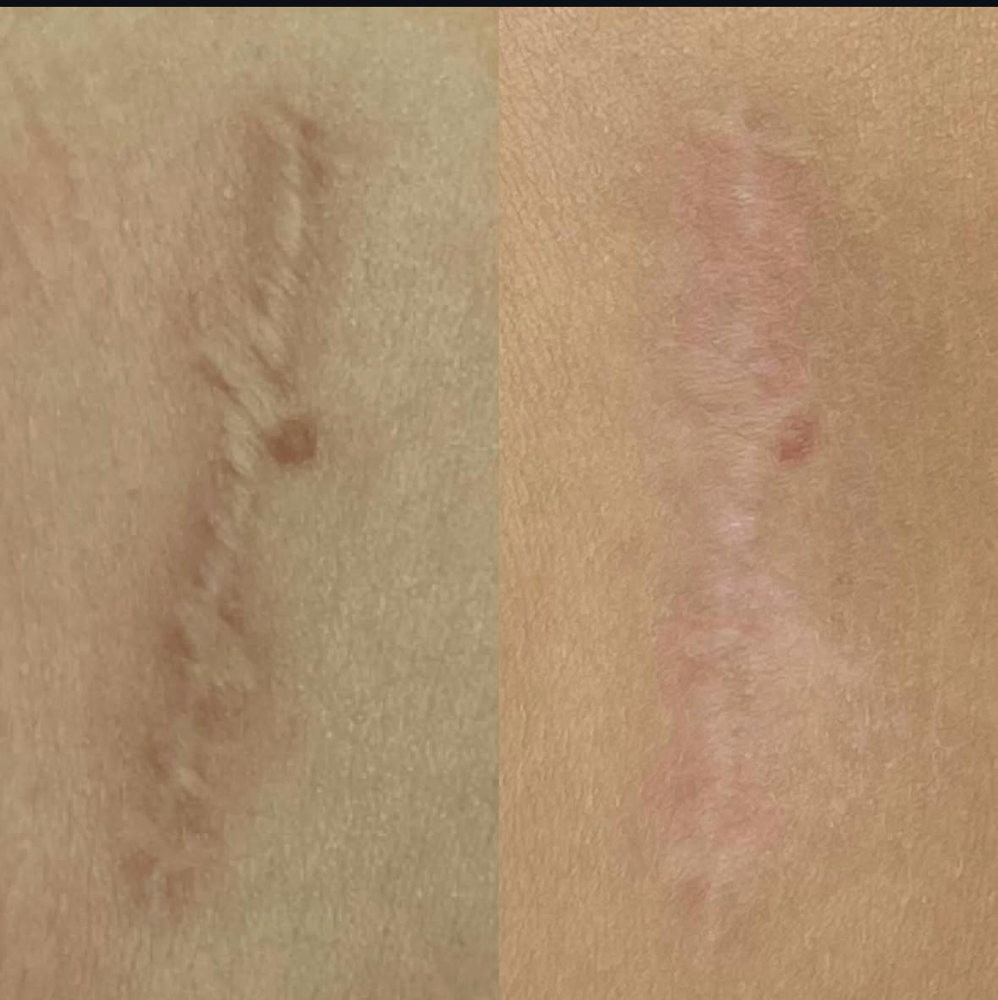 Scar Micro-Needling