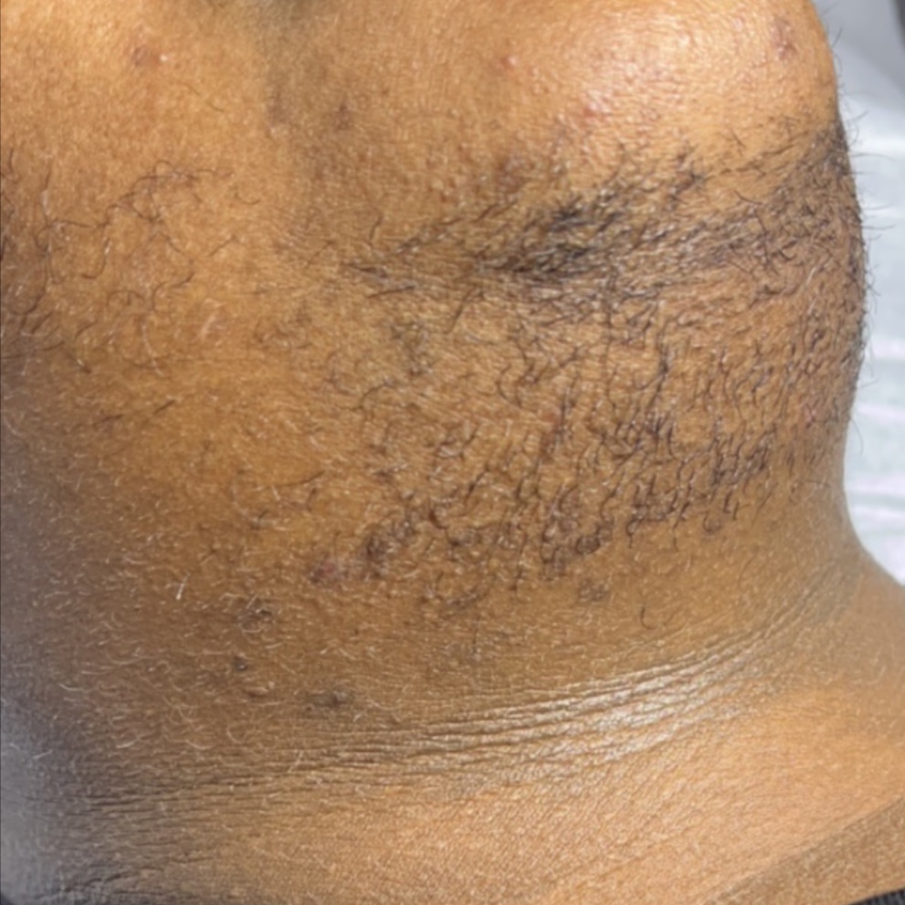PCOS Full Neck Wax at The Complexion Parlor in Georgetown, SC