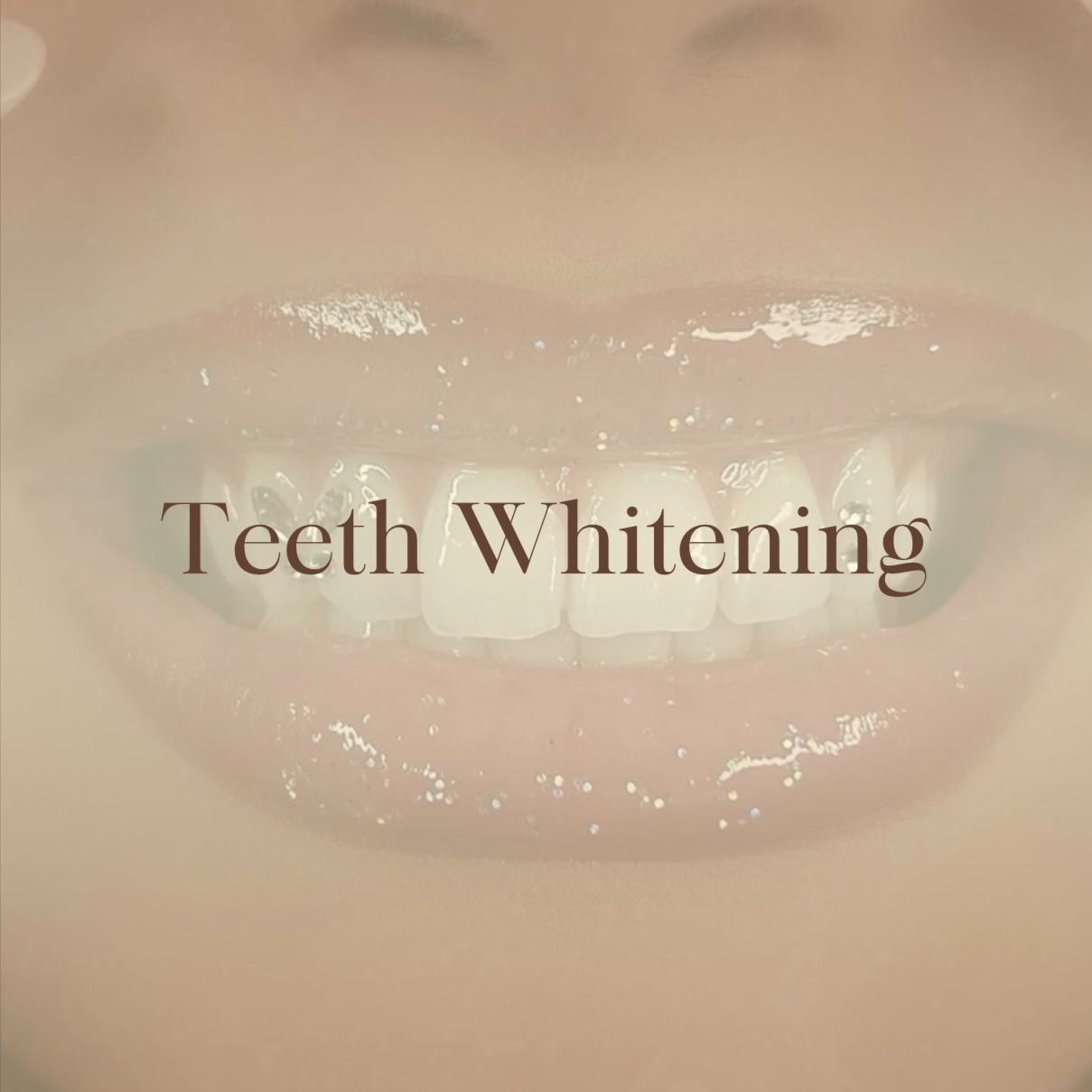 Teeth Whitening at Kat-Le Studio in Thousand Oaks, CA