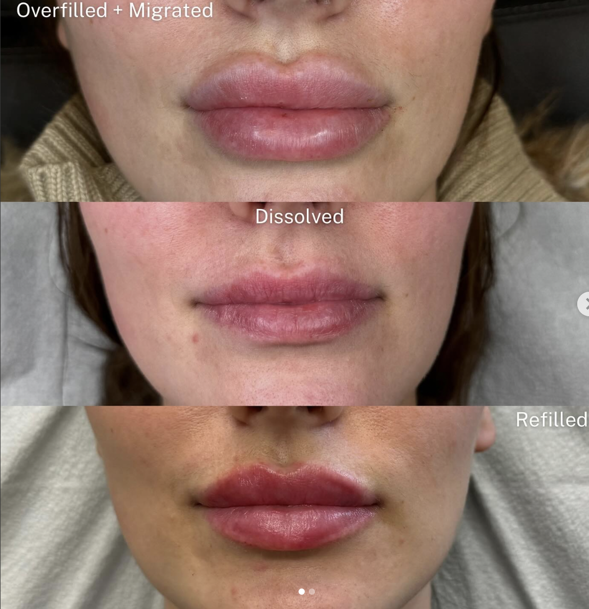 Lip Rehab