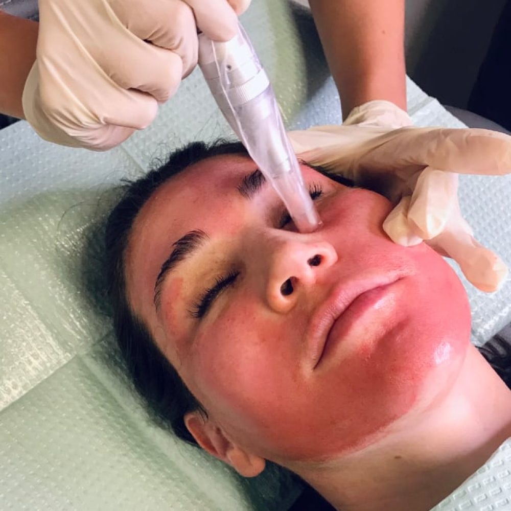 Korean Glow MICRONEEDLING at Serene Head Spa in Mansfield, TX