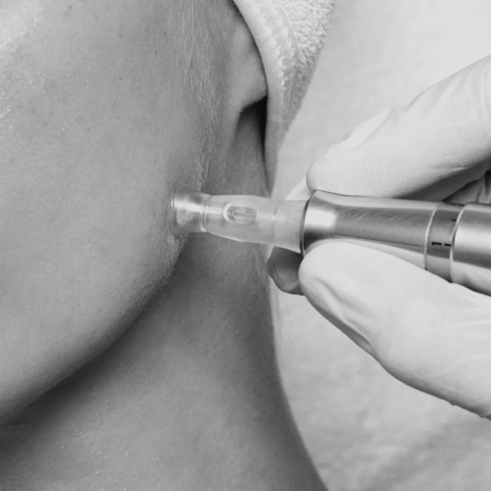 Microneedling at TheBlendedCollective in Greenwood, IN