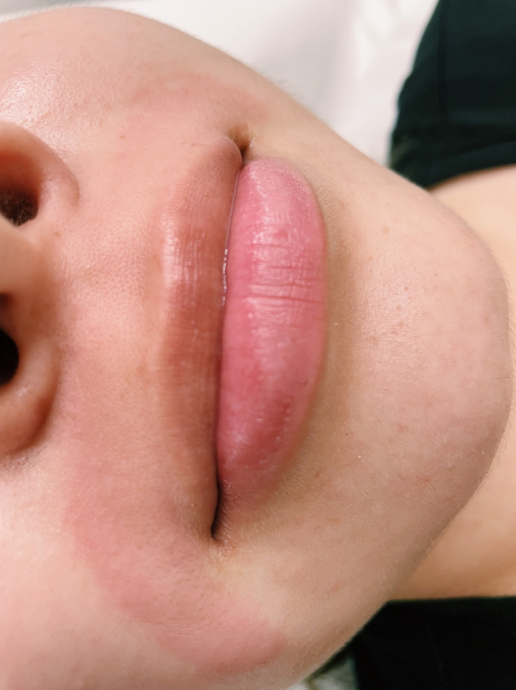 Lip Or Chin