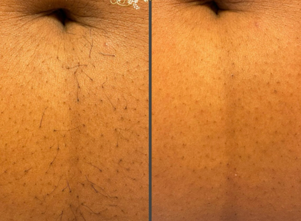 Stomach Strip