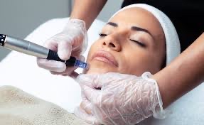 Microneedling