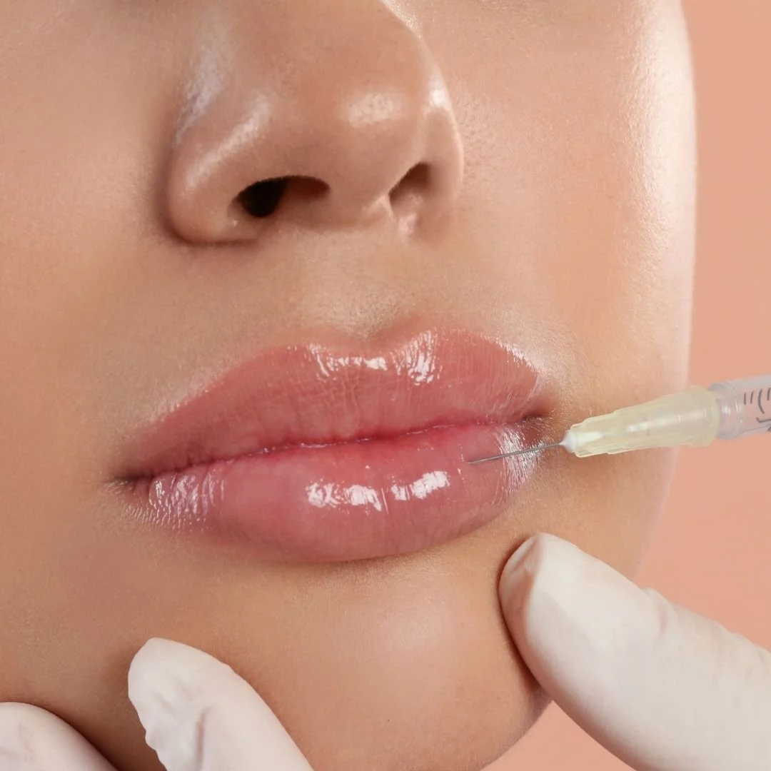 Dermal Filler at Stony Point Spa in Watertown, SD