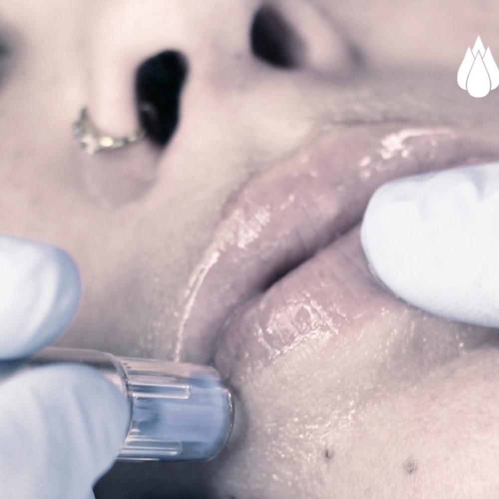 Rezenerate Nano-Infusion Treatment at Aqua One Skin Clinic in Jasper, IN