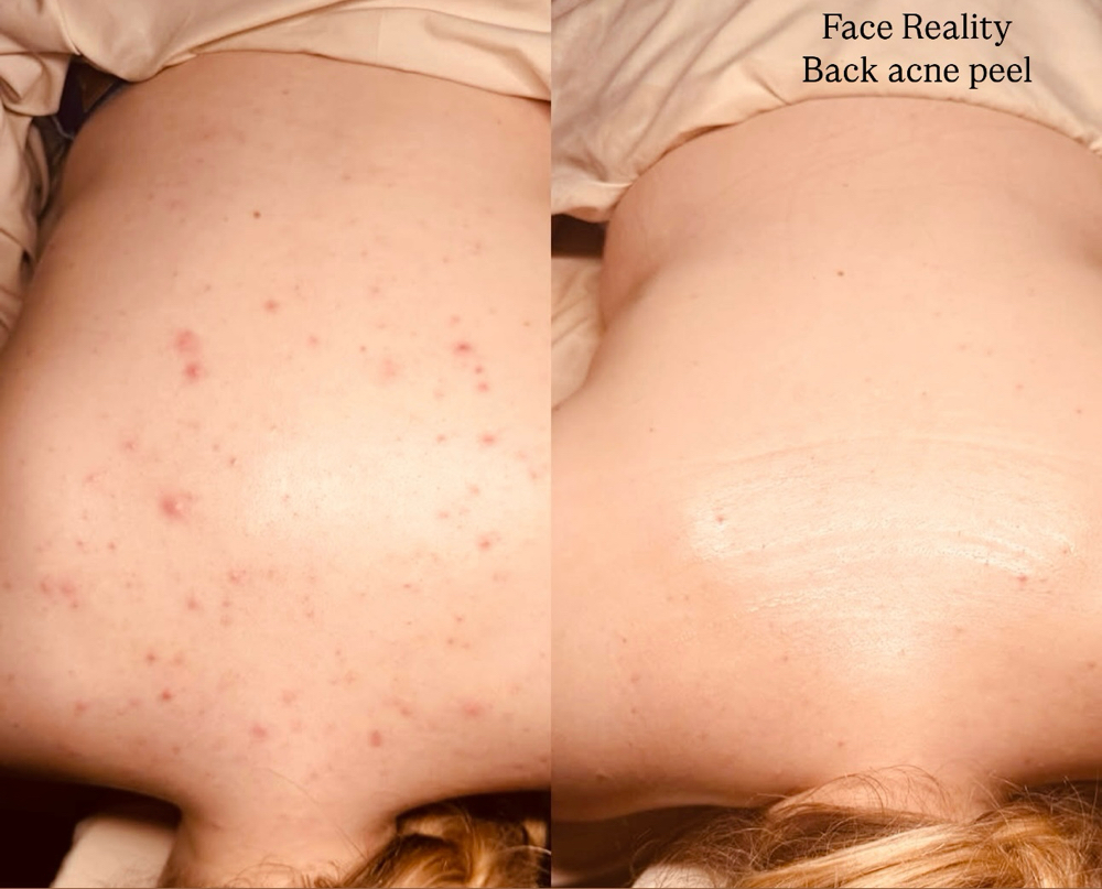 Clear Skin Back Peel Treatment at The Glow Room, LLC in Lawrenceburg, KY