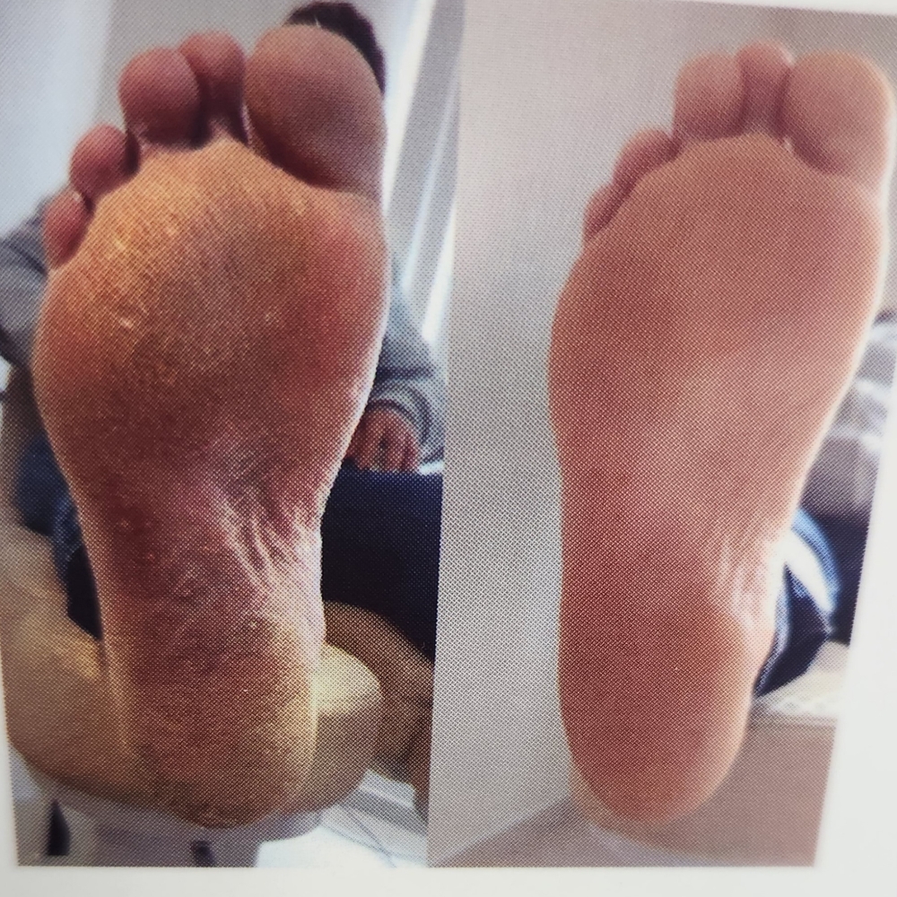 Rejuvinating Callus-softening Treat