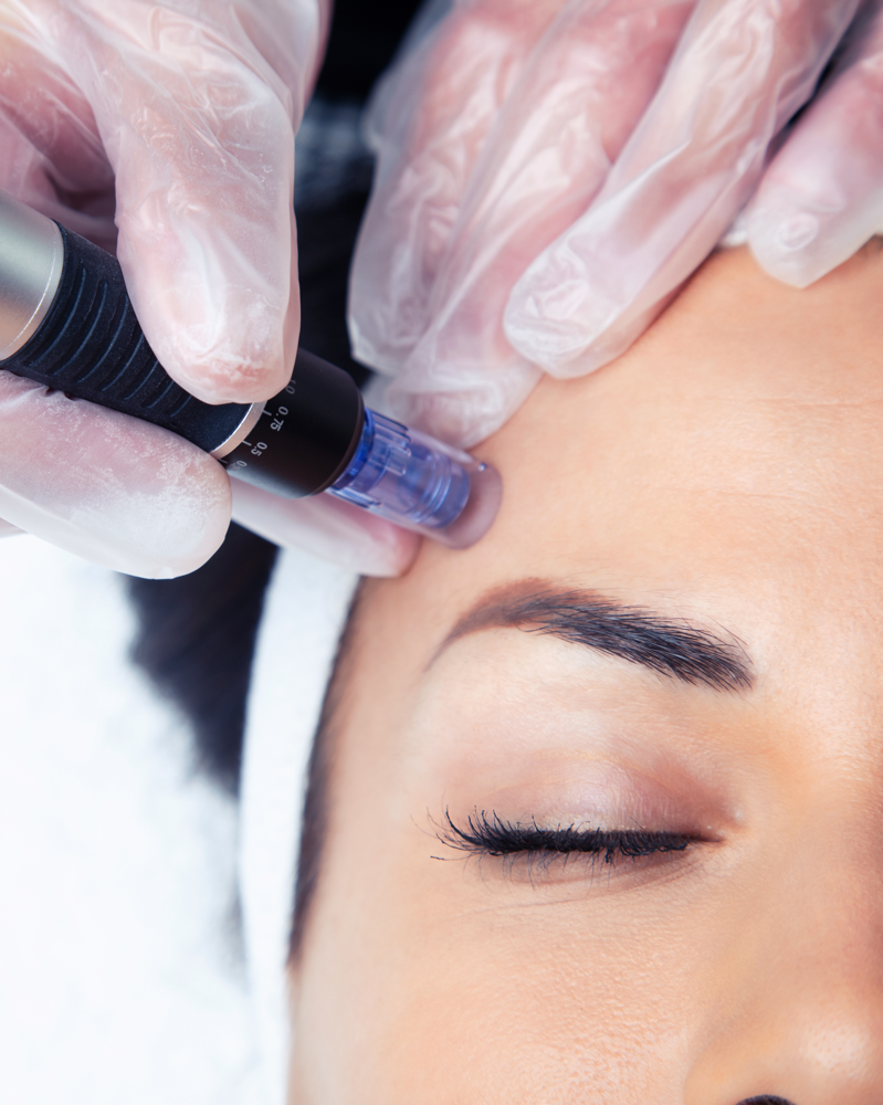 Microneedling + Exosomes