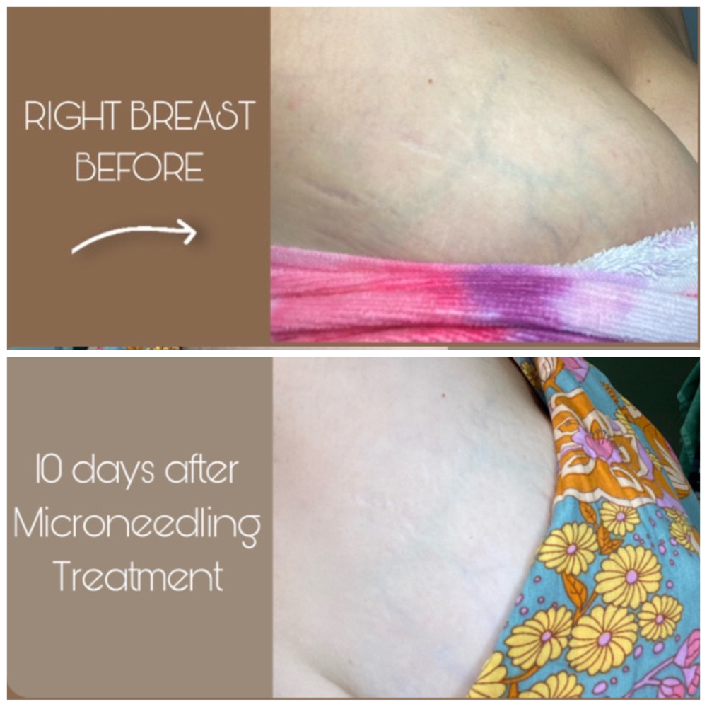 MICRONEEDLE STRETCH MARK REDUCTION