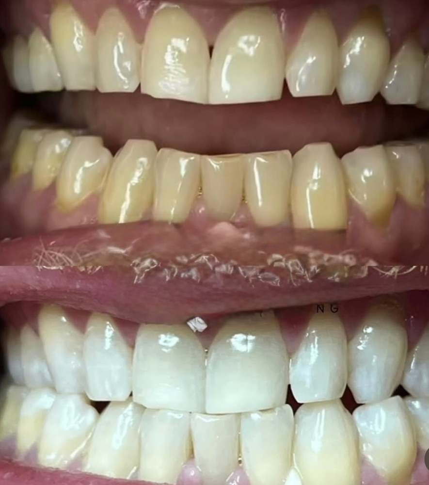 Bright Whitening