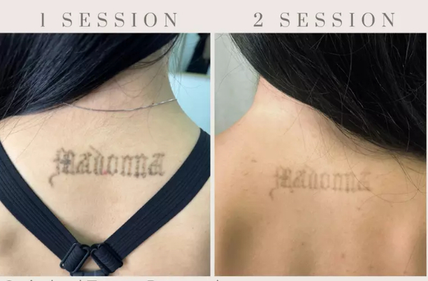 Laser Tattoo Removal