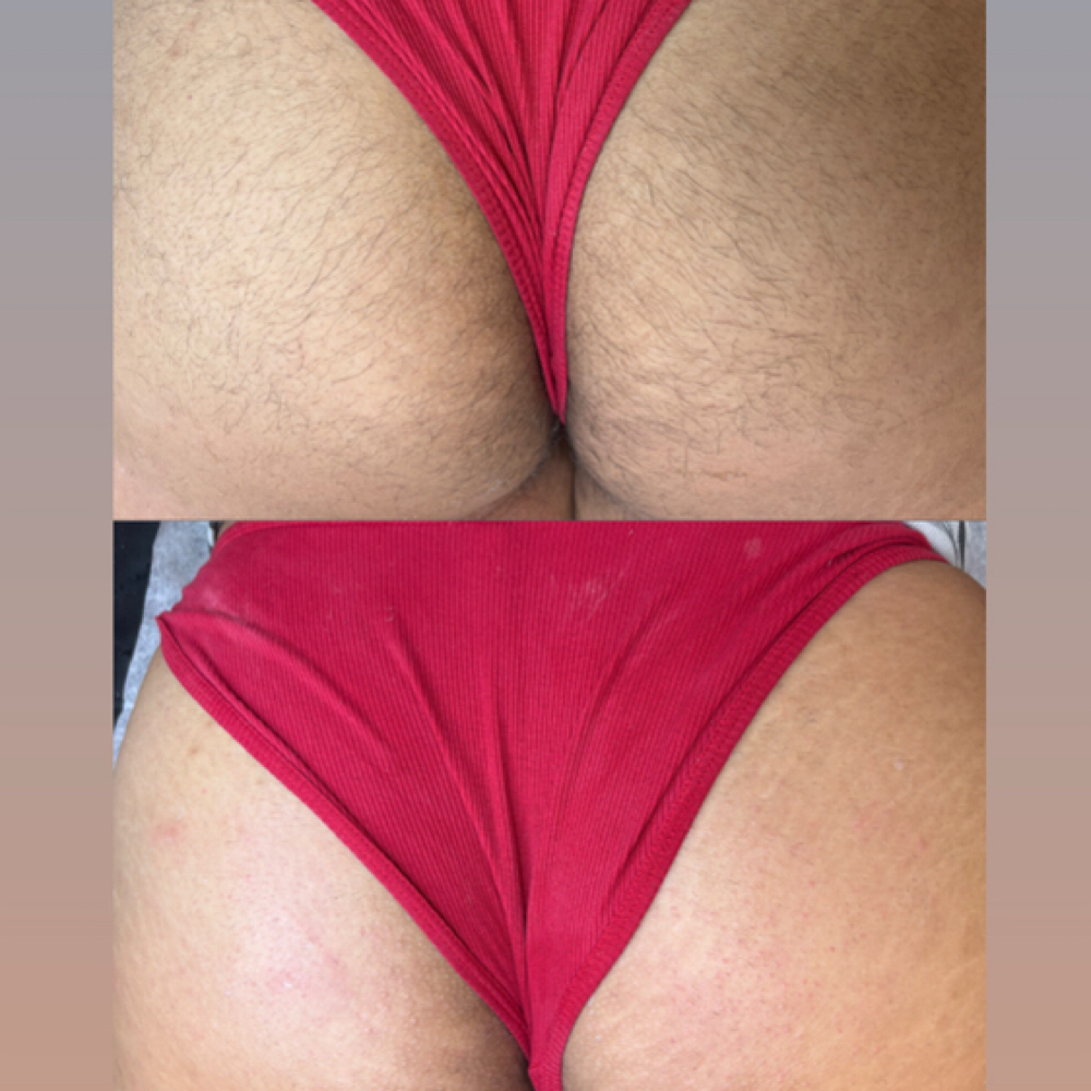 Buttock Wax at Tesoro Luxe Aesthetics in San Antonio, TX