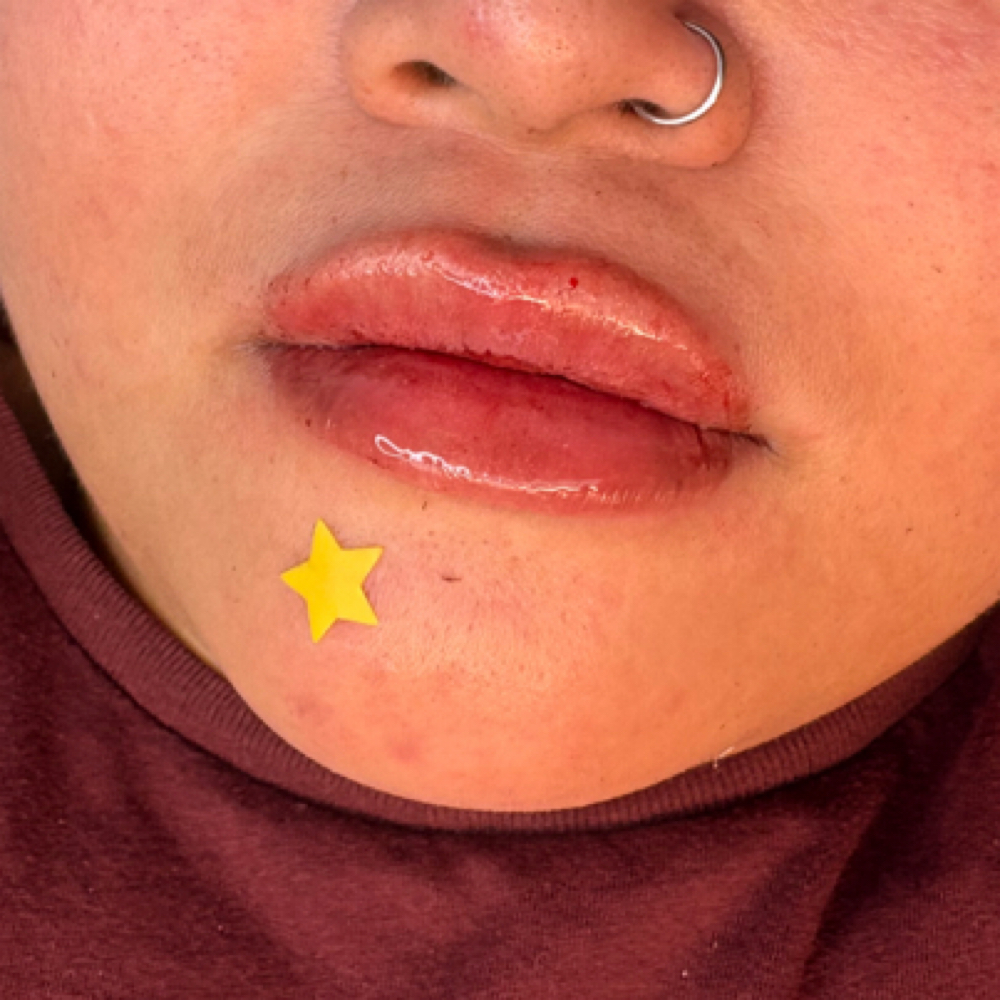 Lip Filler 1ml at Balance.Bar.Aesthetics in Berkeley, CA