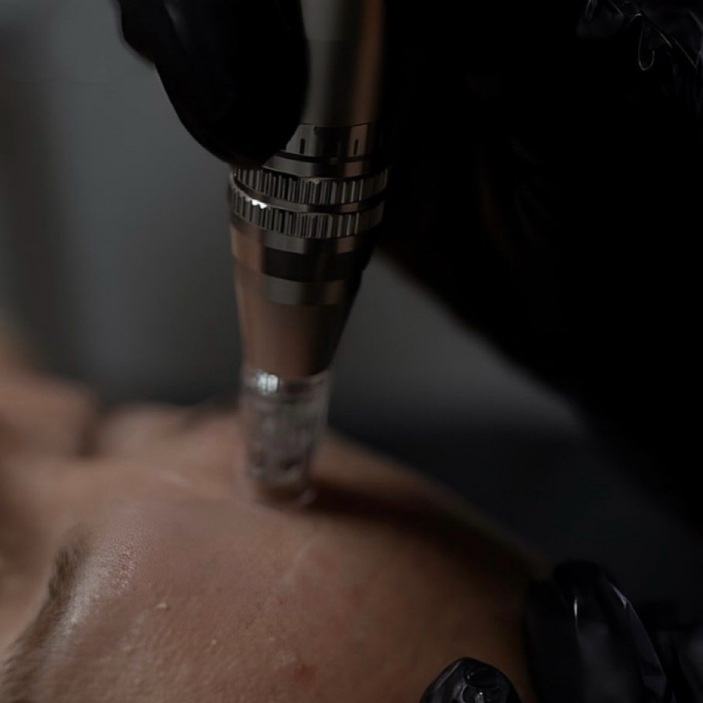 Microneedling at Simply Bespoke Aesthetics in Baltimore, MD