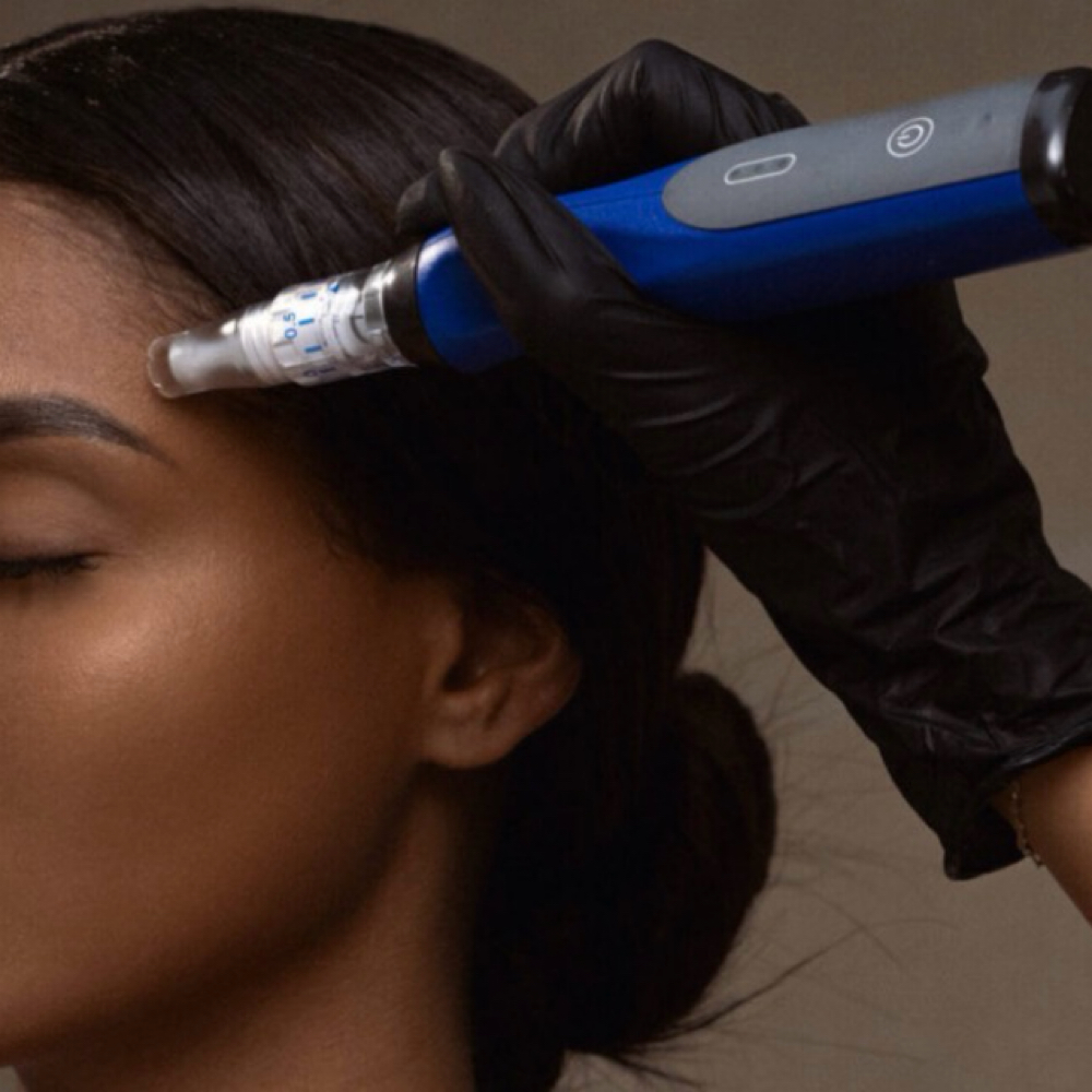 Microneedling Package (3) at BioBeautyAesthetics in Roseville, CA