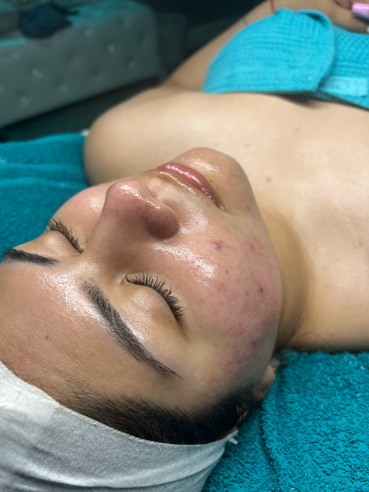 ACNE FACIAL