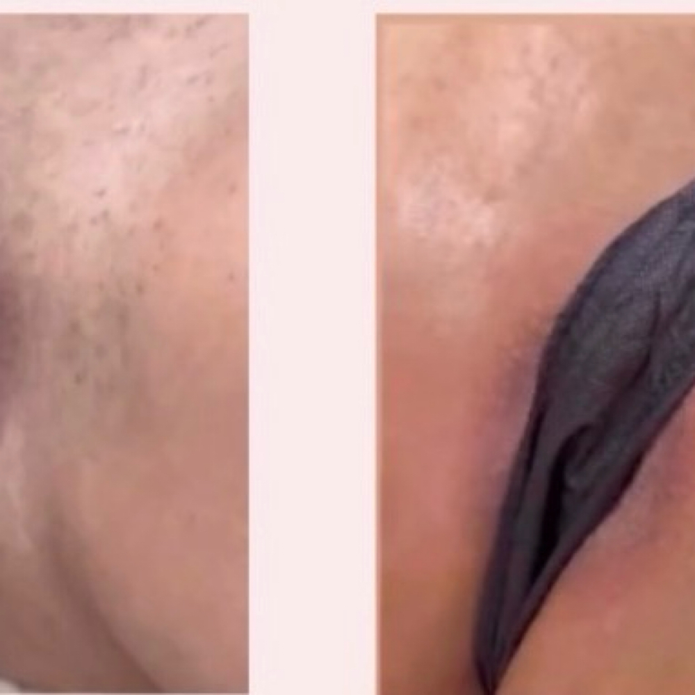 Brazilian Area Skin Brightening at marisbeautylounge_ in Huntington Park, CA