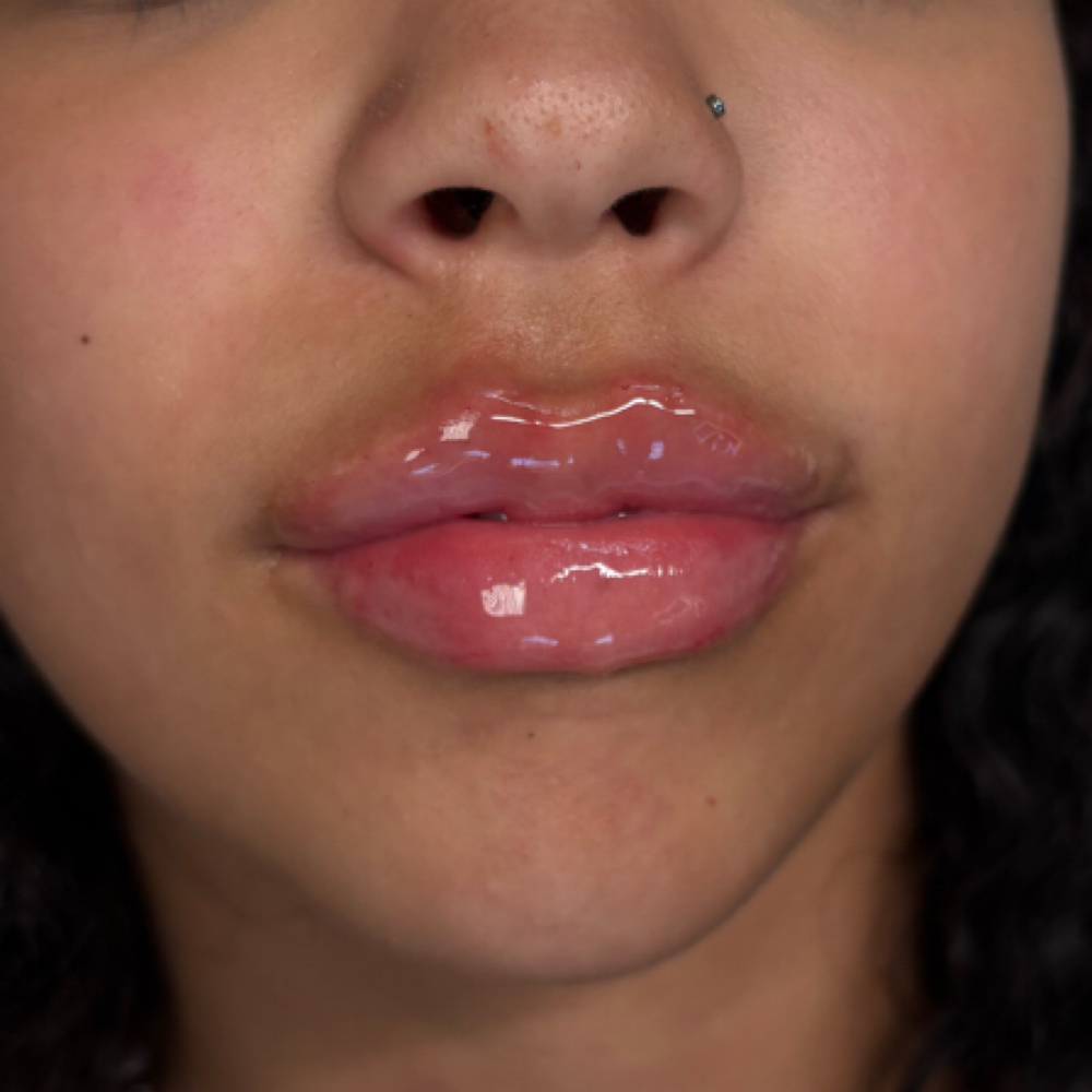 1ML Signature Lip Filler at Eluxy Aesthetics in Arlington, TX