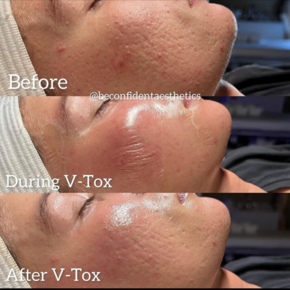 Vtox Lift & Firm Facial at Skin By Carly in LaFayette, GA
