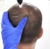 Micro-needling Scalp (4)