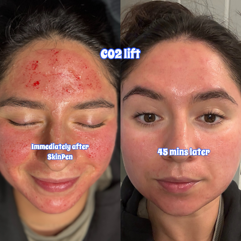 SkinPen + CO2Lift Pro at Alchemy Skin in Lewisville, TX