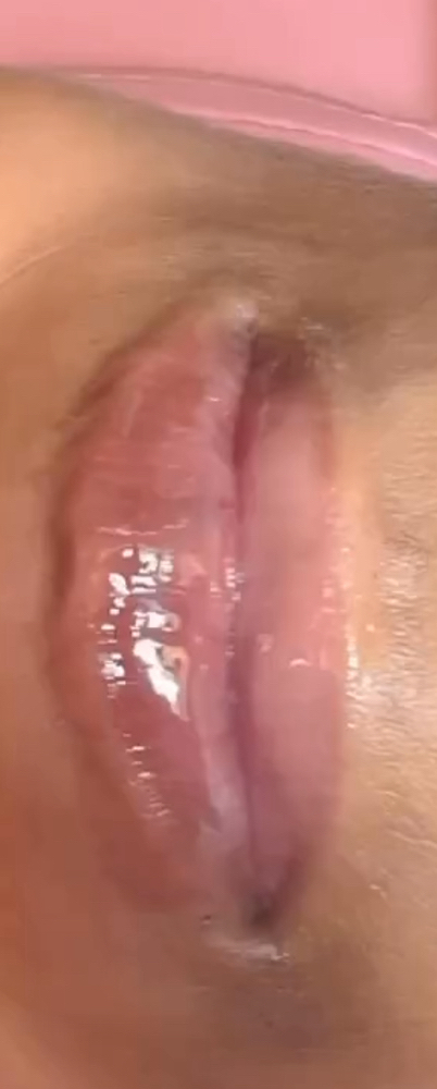 Needless lip filler