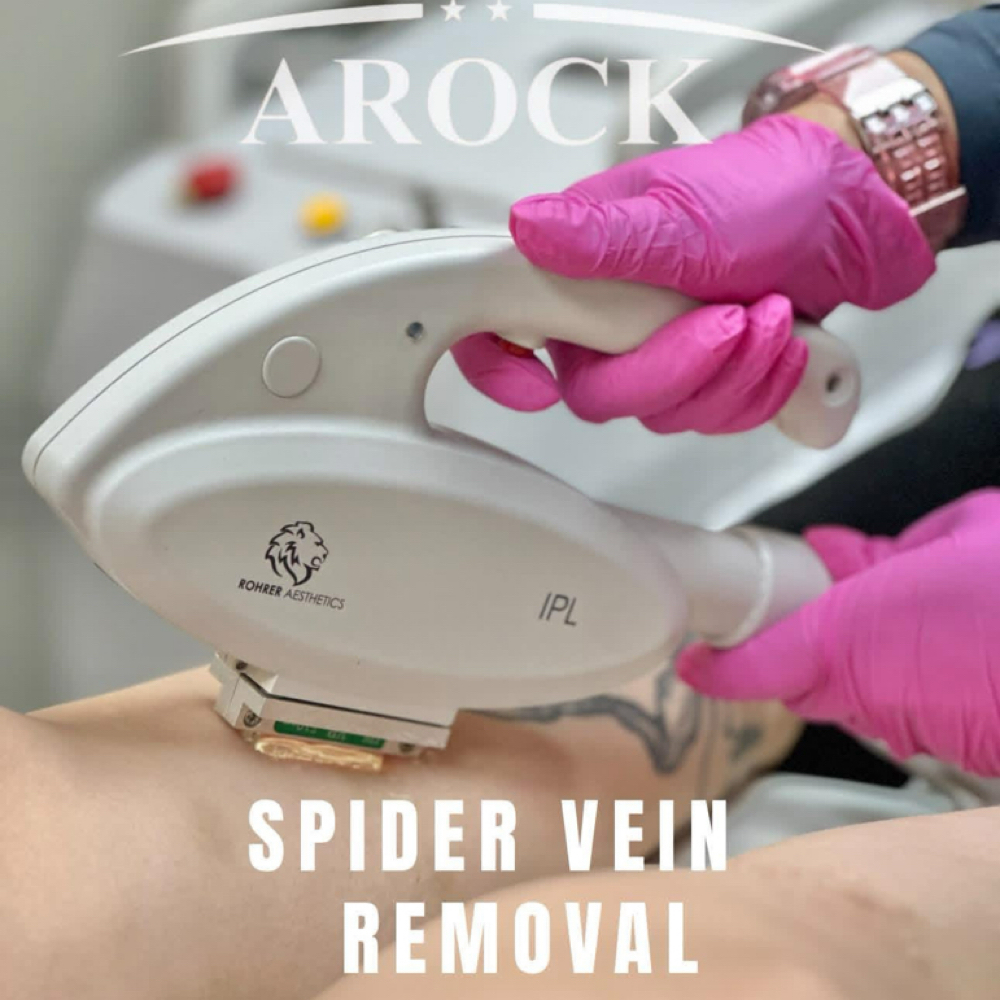 Spider Vein Removal at ARock Beauty & Wellness in San Angelo, TX