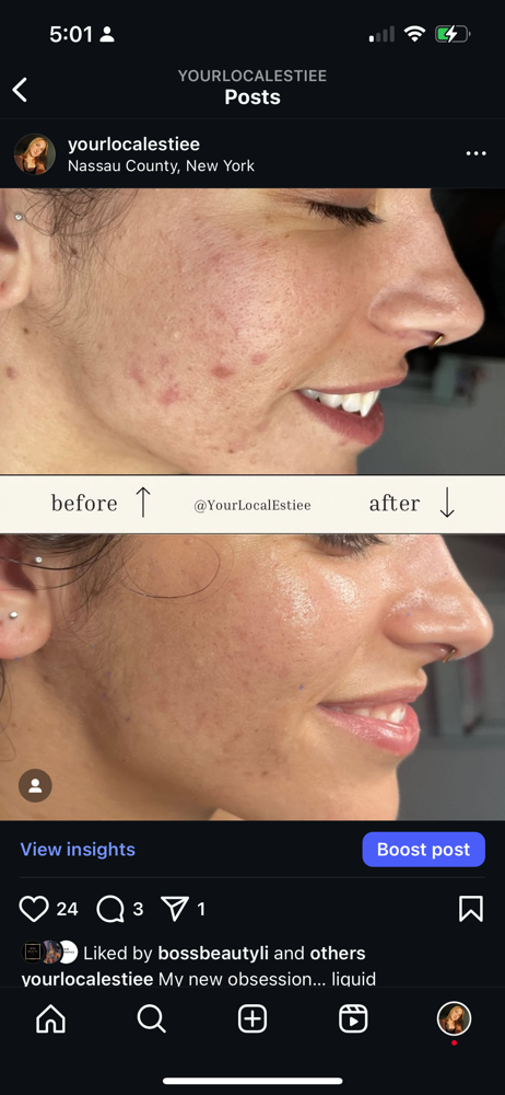 Microneedling
