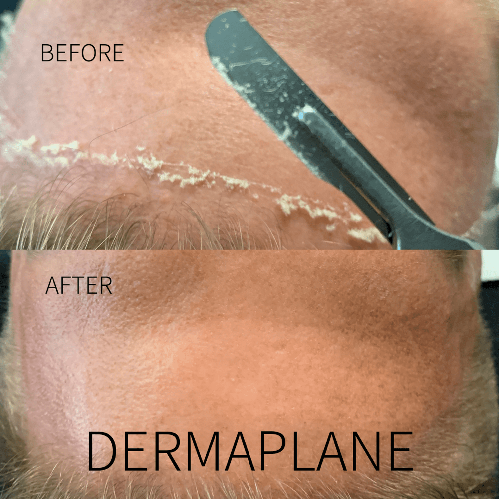 Dermaplaning Facial