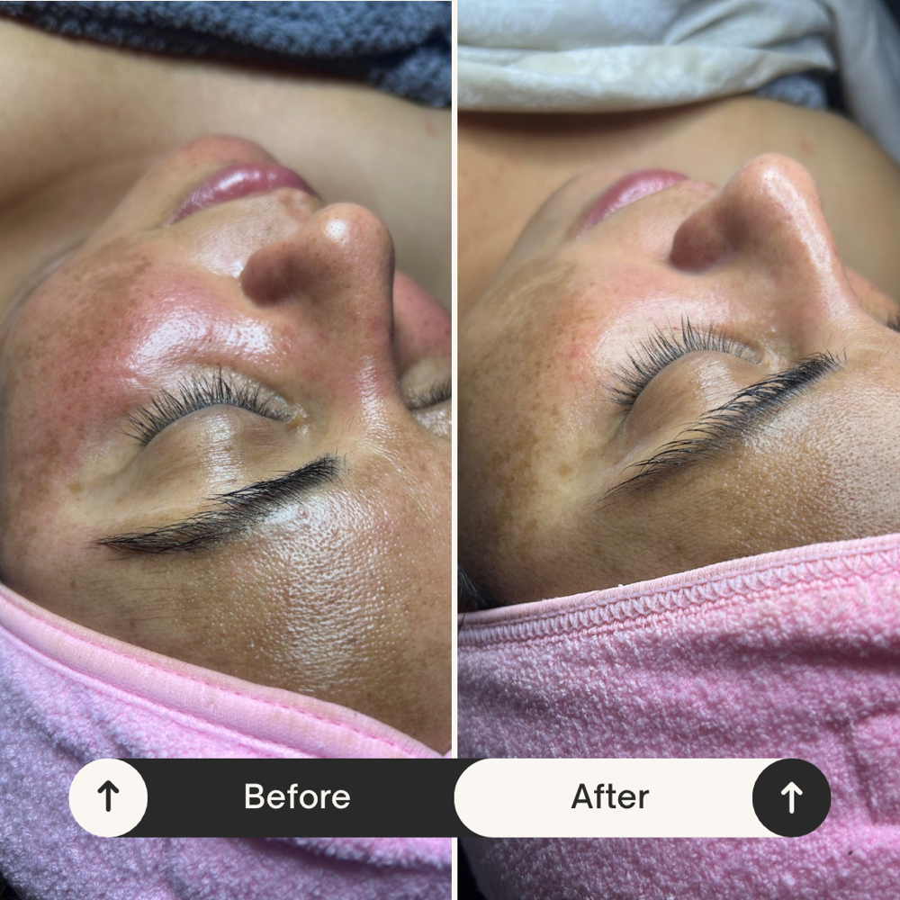 Enzyme facial