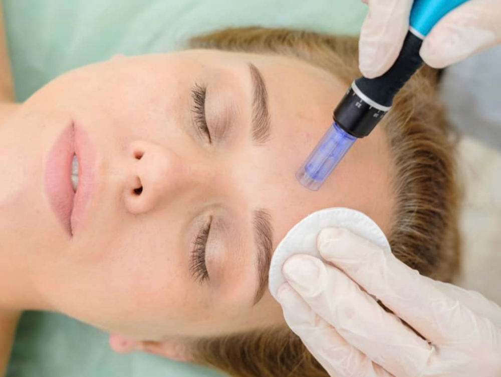 MicroNeedling