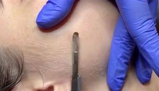 Dermaplaning facial