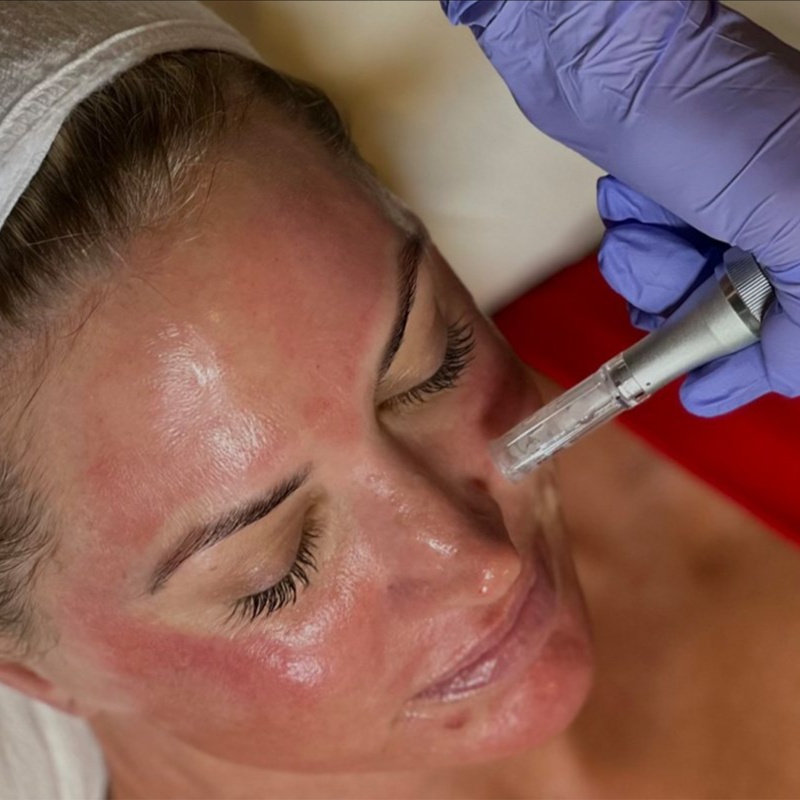 Microneedling Therapy at Velvet Skin Aesthetics in Omak, WA