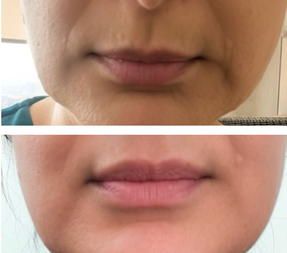 .5 ml - New Clients