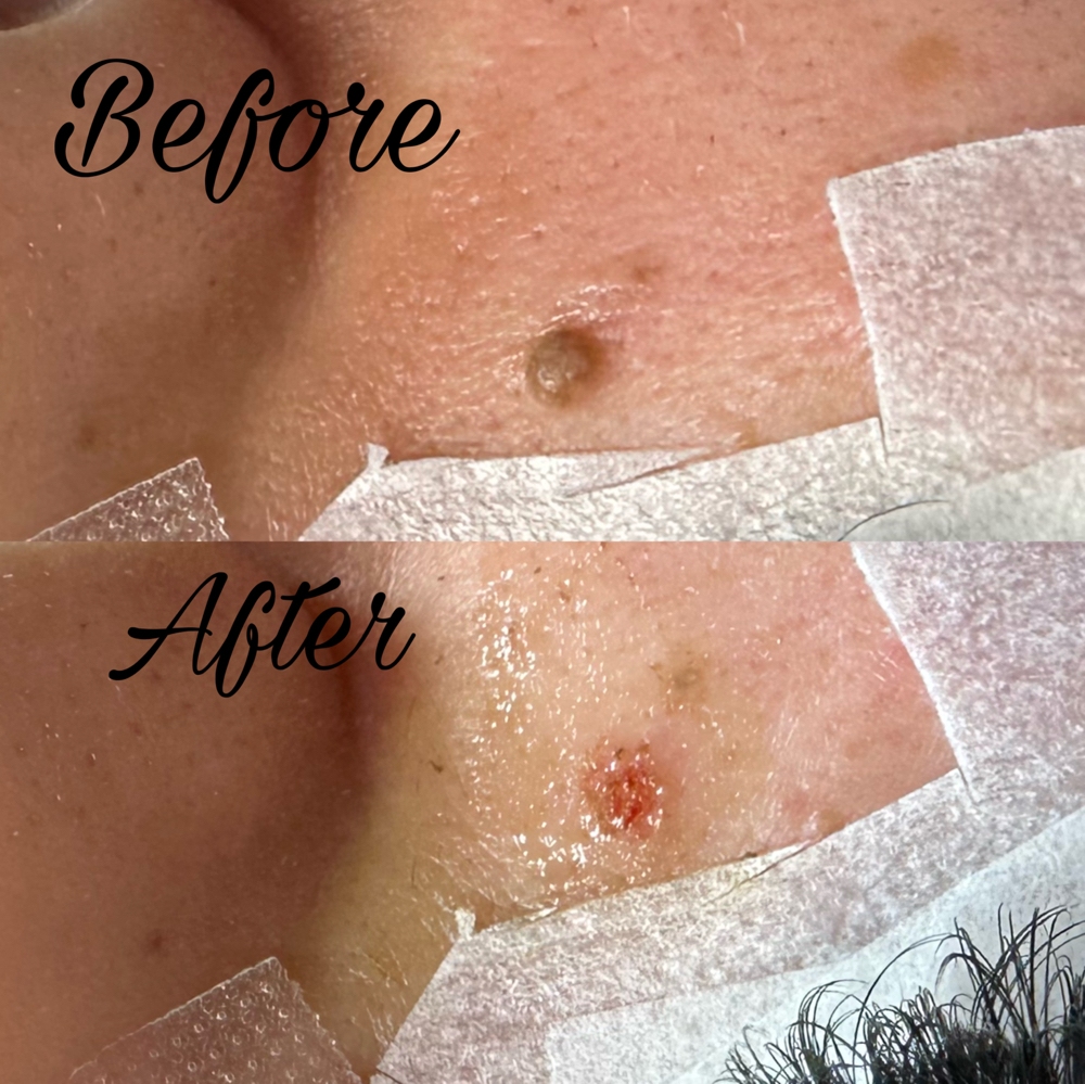 Skin Tag & Black Mole Removal